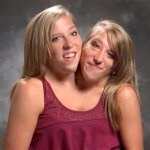 A Rare and Fascinating Conjoined Twin Condition