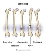 Claims Five: Why Does a Broken Leg Mean the End for a Horse? | Horse Racing