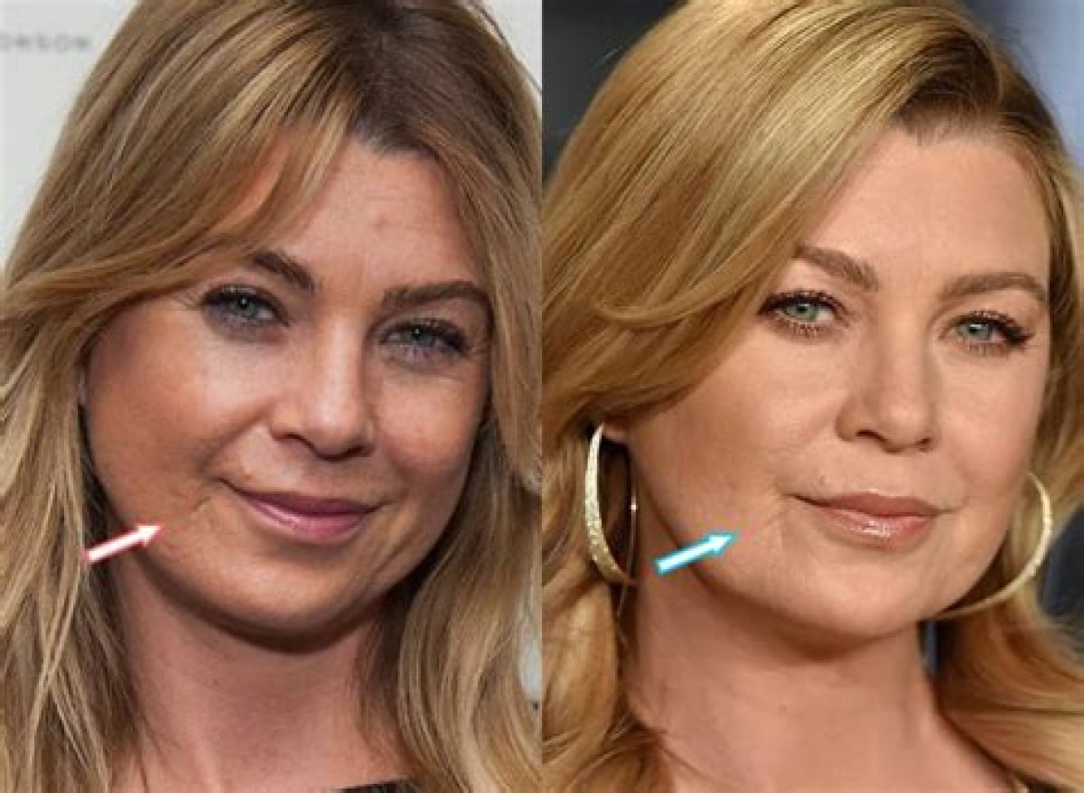 Ellen Pompeo's Lip Filler Journey: a Closer Look