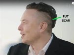 Elon Musk's Scar and Its Untold Story