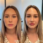 Mackenzie Ziegler Nose Job Botox and Lip: Unveiling the Truth