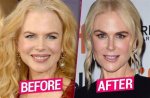 Nicole Kidman Facelift: a Comprehensive Look at Her Transformation