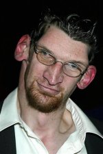 Understanding Matthew Mcgrory's Disease: a Deep Dive into Acromegaly